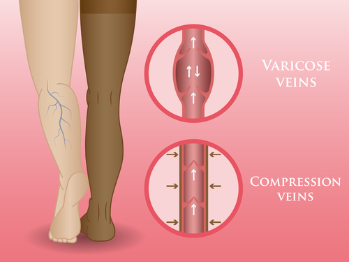 Medical Clinic: Do compression socks help varicose veins?